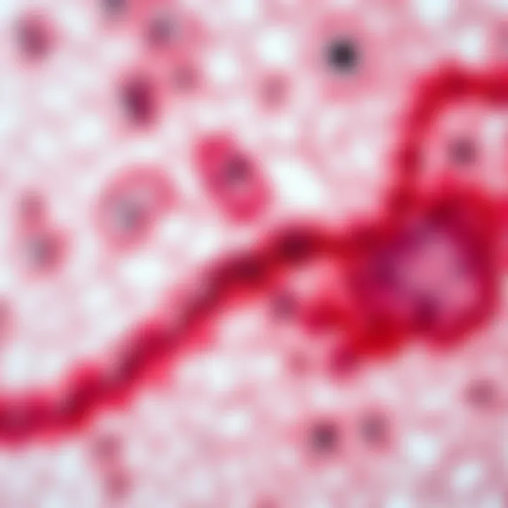 Pathological Insights into Cecal Adenocarcinoma Illustration of cecal adenocarcinoma pathology