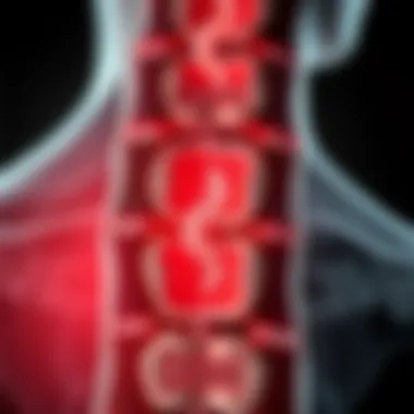 Illustration of spinal canal narrowing due to stenosis
