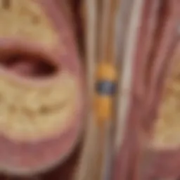 Cross-sectional view of the spine highlighting ligamentum flavum hypertrophy.